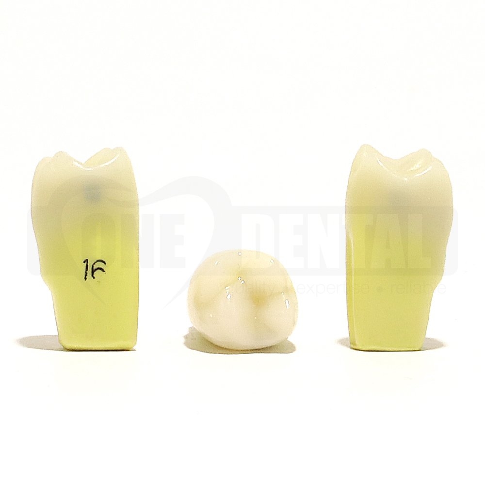 Caries tooth 16MD for 2010 Adult Model