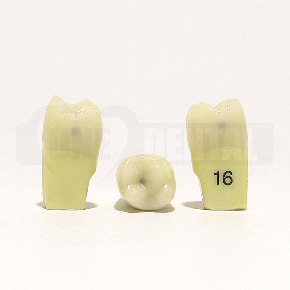 Caries tooth 16MOD for 2010 Adult Model