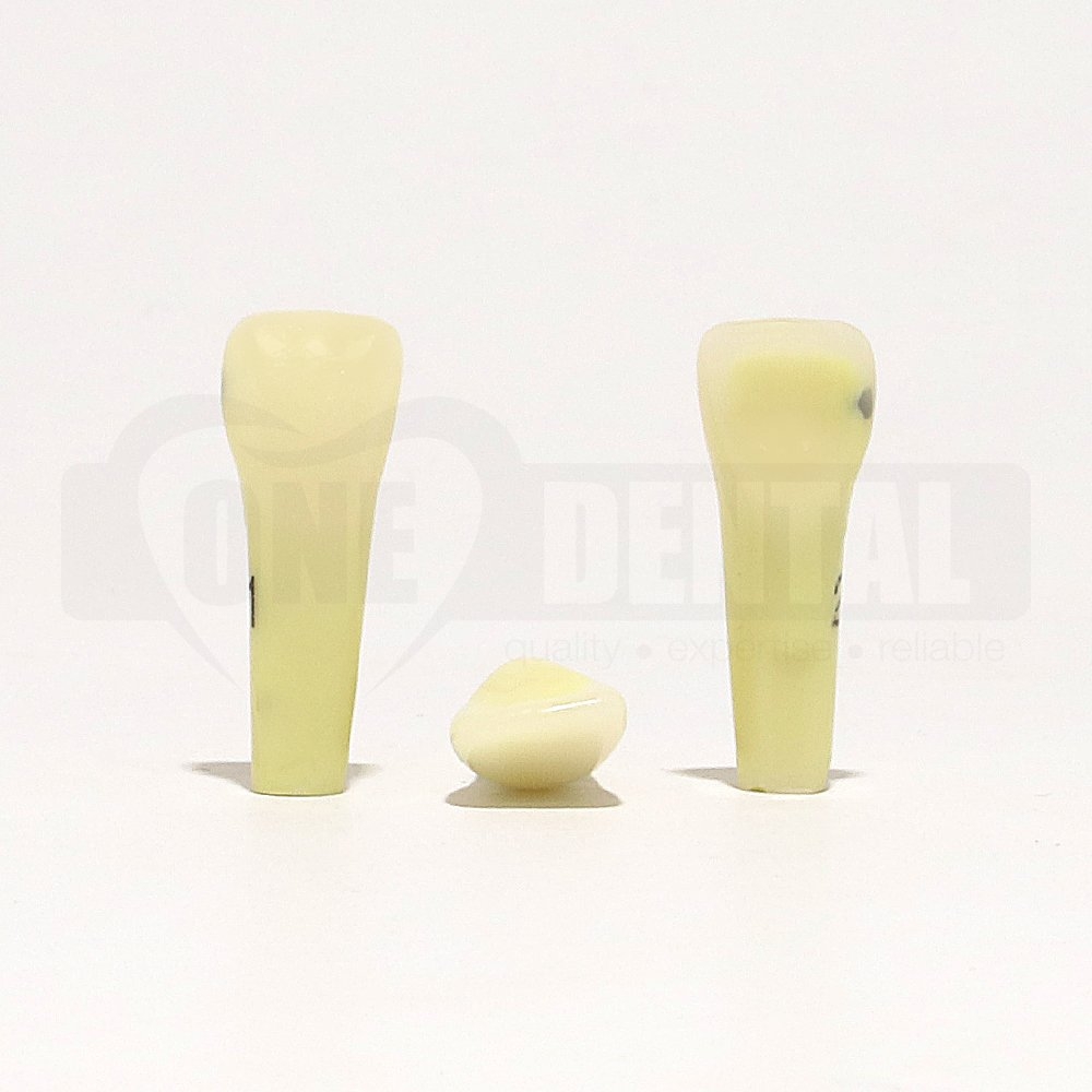 Caries tooth 21D for 2010 Adult Model