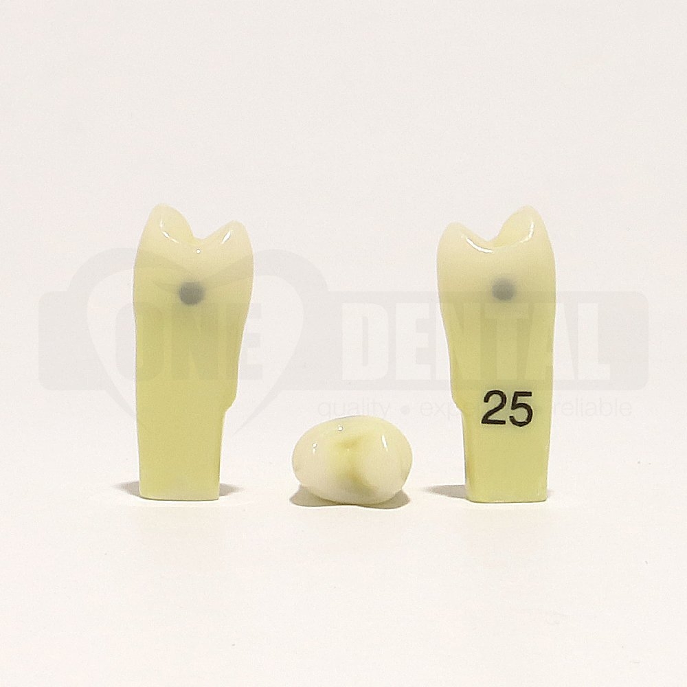 Caries Tooth 25 M & D for 2010 Adult Model