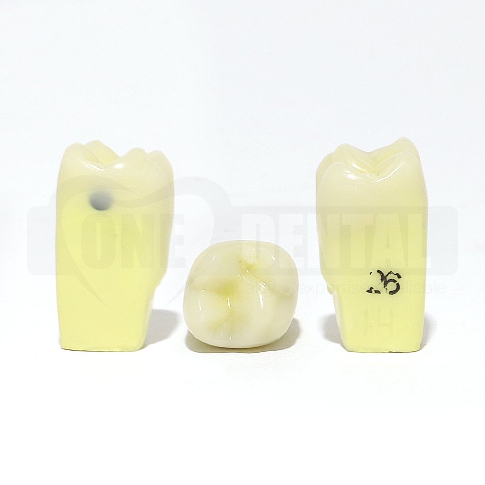 Caries Tooth 26M for 2010 Adult Model