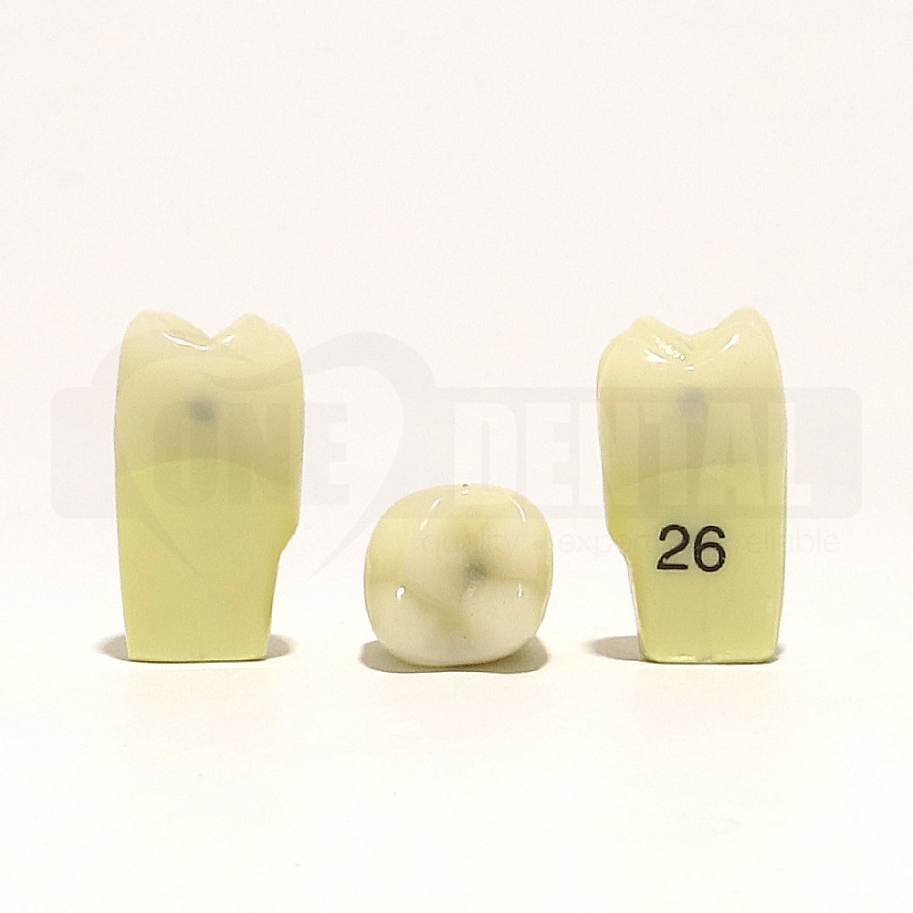 Caries tooth 26MOD for 2010 Adult Model