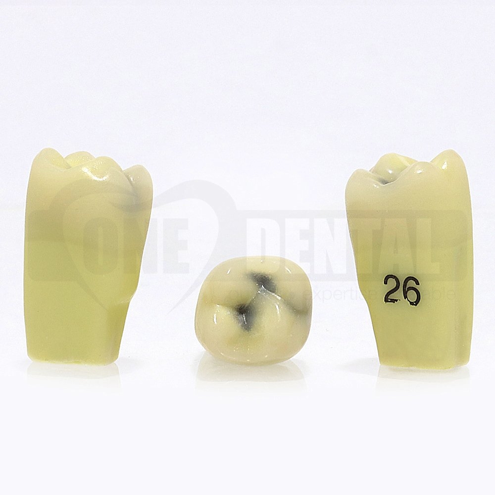 Caries Tooth 26 Occ + L GW Extended Adult Scope for 2010 Adult Model