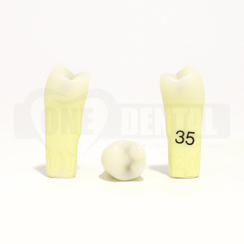 Caries Tooth 35 MOD for 2010 Adult Model MT