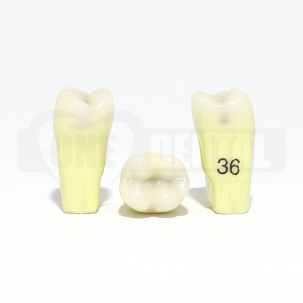 Caries Tooth 36 MOD for 2010 Adult Model