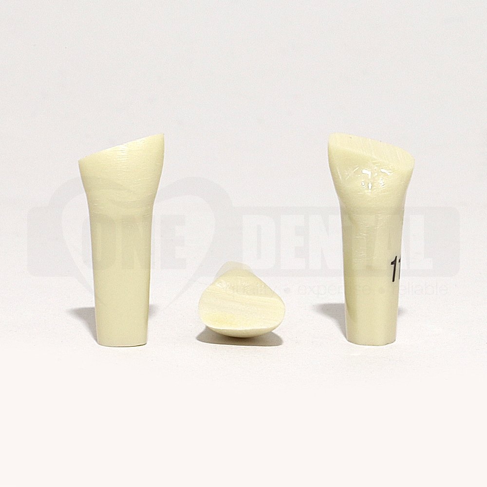 Prep Tooth 11 Mesial Incisal Distal Fracture PC for 2010 Adult Model