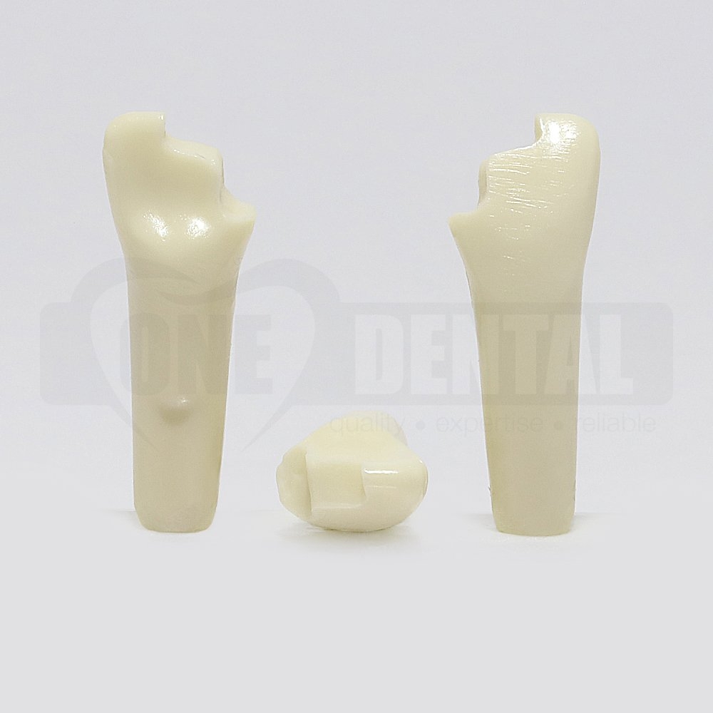 Prep Tooth 21 FRAC Distal - JK for 2010 Adult Model