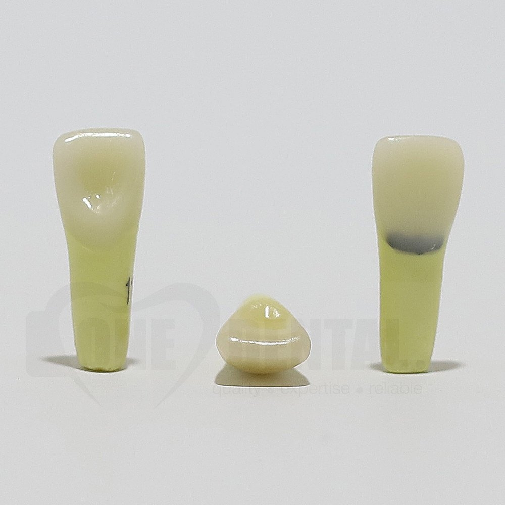 Caries Tooth 11 Cervical for ADC Model