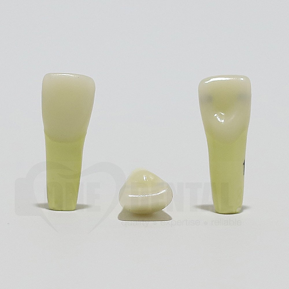 Caries Tooth 11 M+D for ADC Model