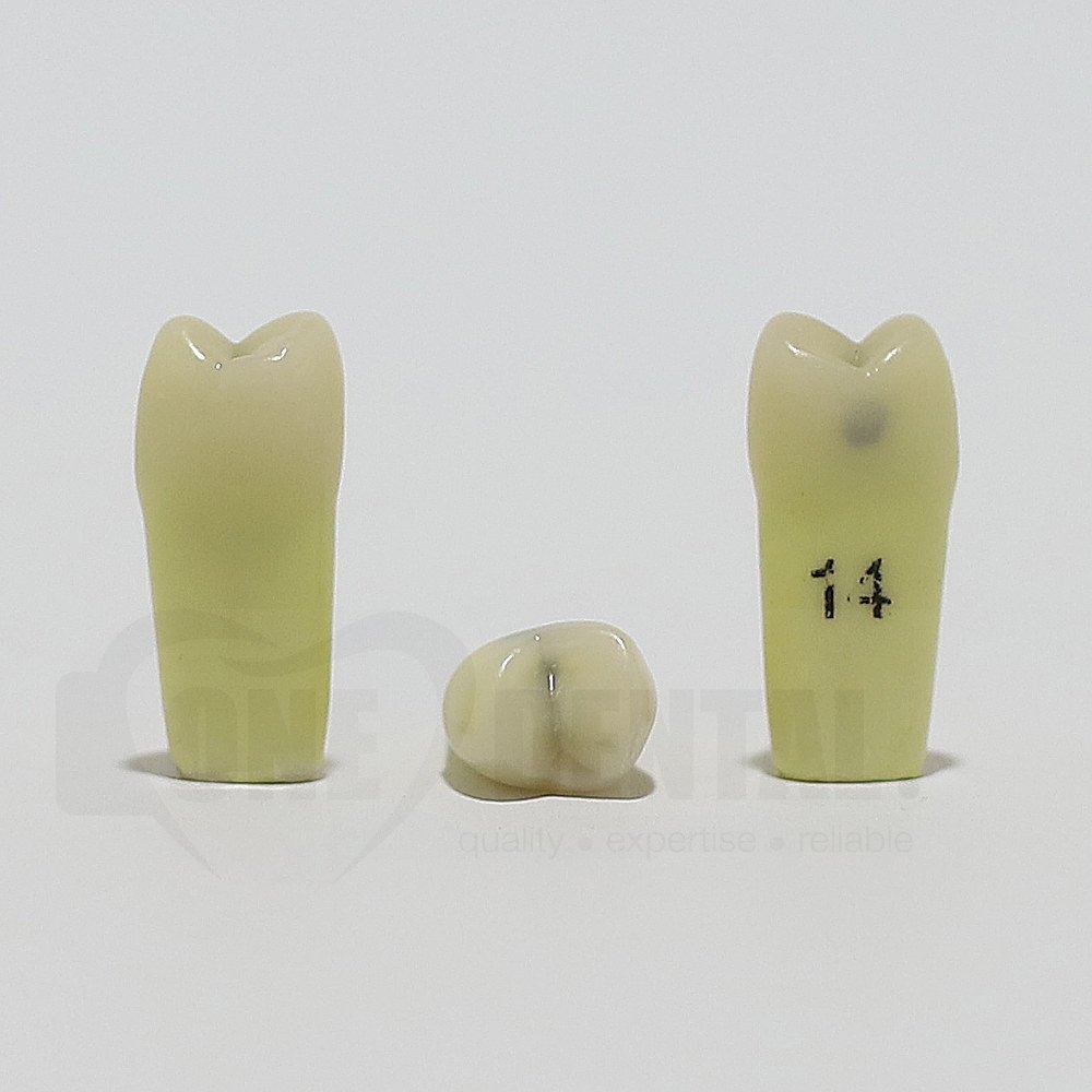 Caries Tooth 14D+O for ADC Model