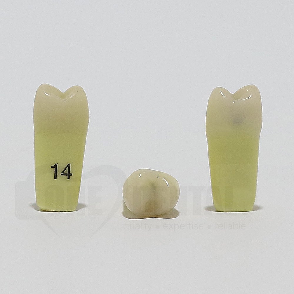 Caries Tooth 14 M+O for ADC Model