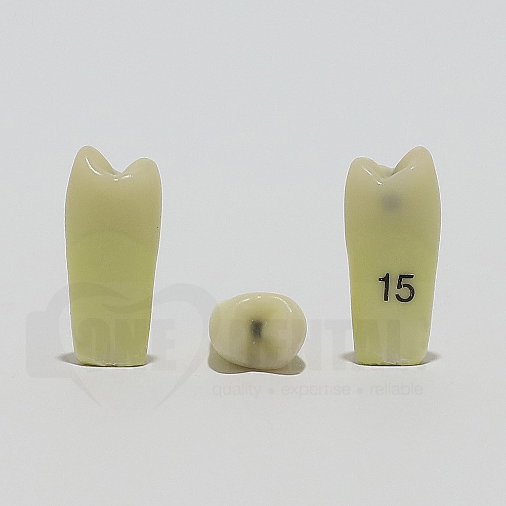 Caries Tooth 15M+O for ADC Model