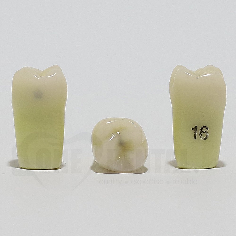 Caries Tooth 16M+O for ADC Model