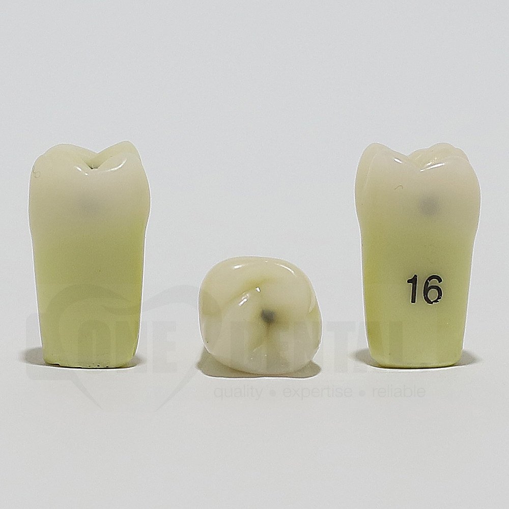 Caries Tooth 16M+O+D for ADC Model