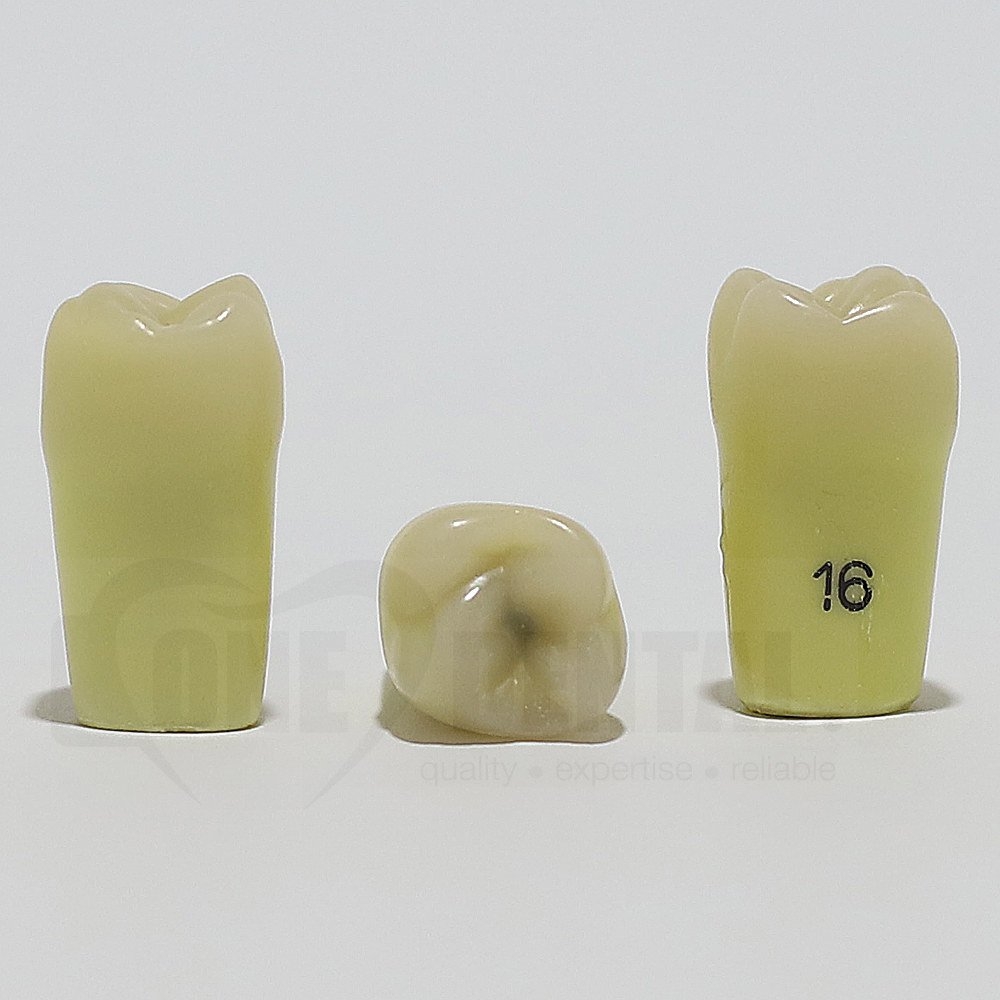 Caries Tooth 16 Occ for ADC Model