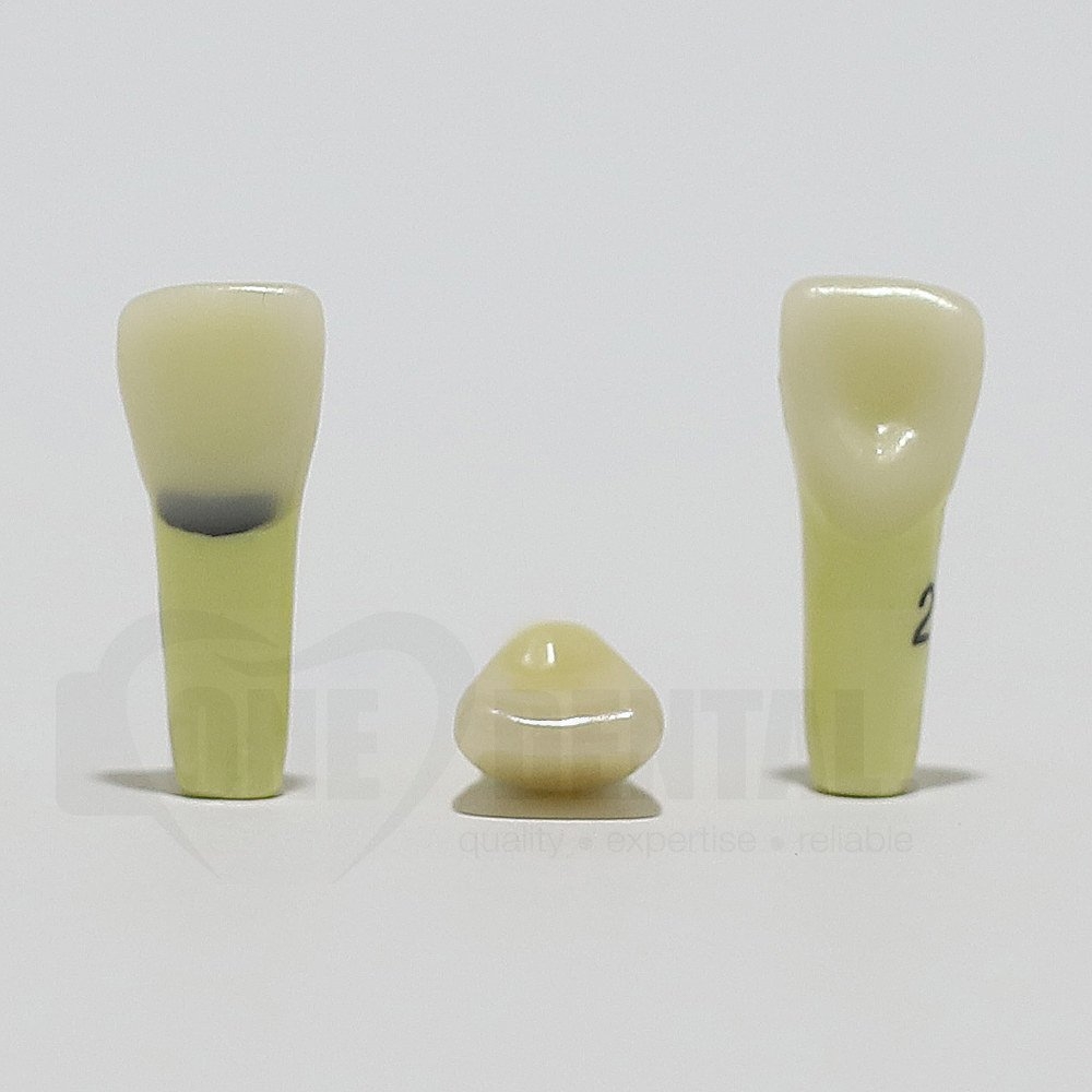 Caries Tooth 21 Cervical for ADC Model