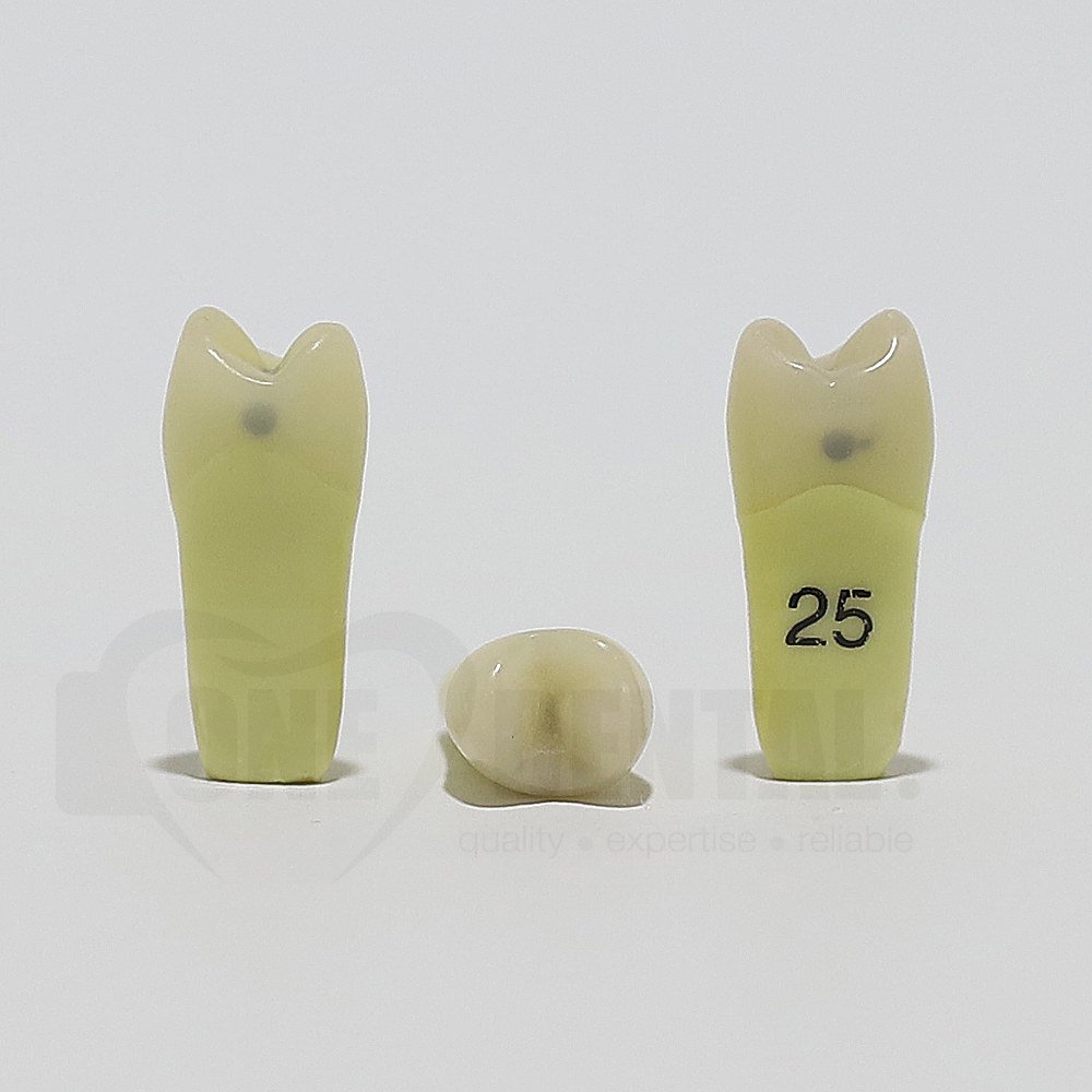 Caries Tooth 25 M+O+D for ADC Model