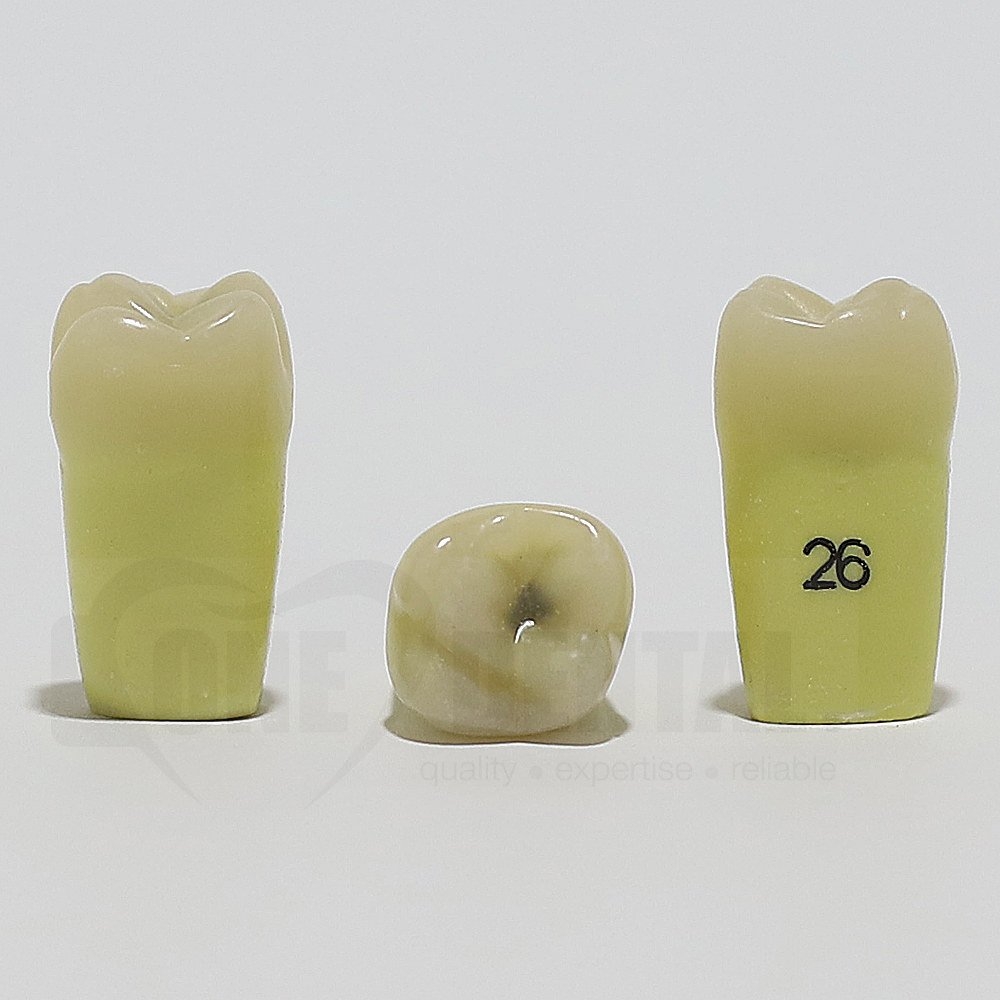Caries Tooth 26 Occ for ADC Model