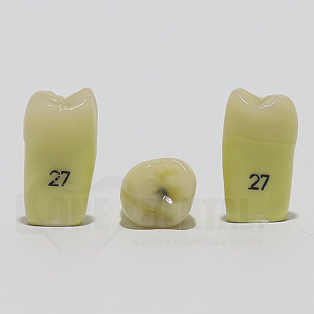Caries Tooth 27Occ for ADC Model