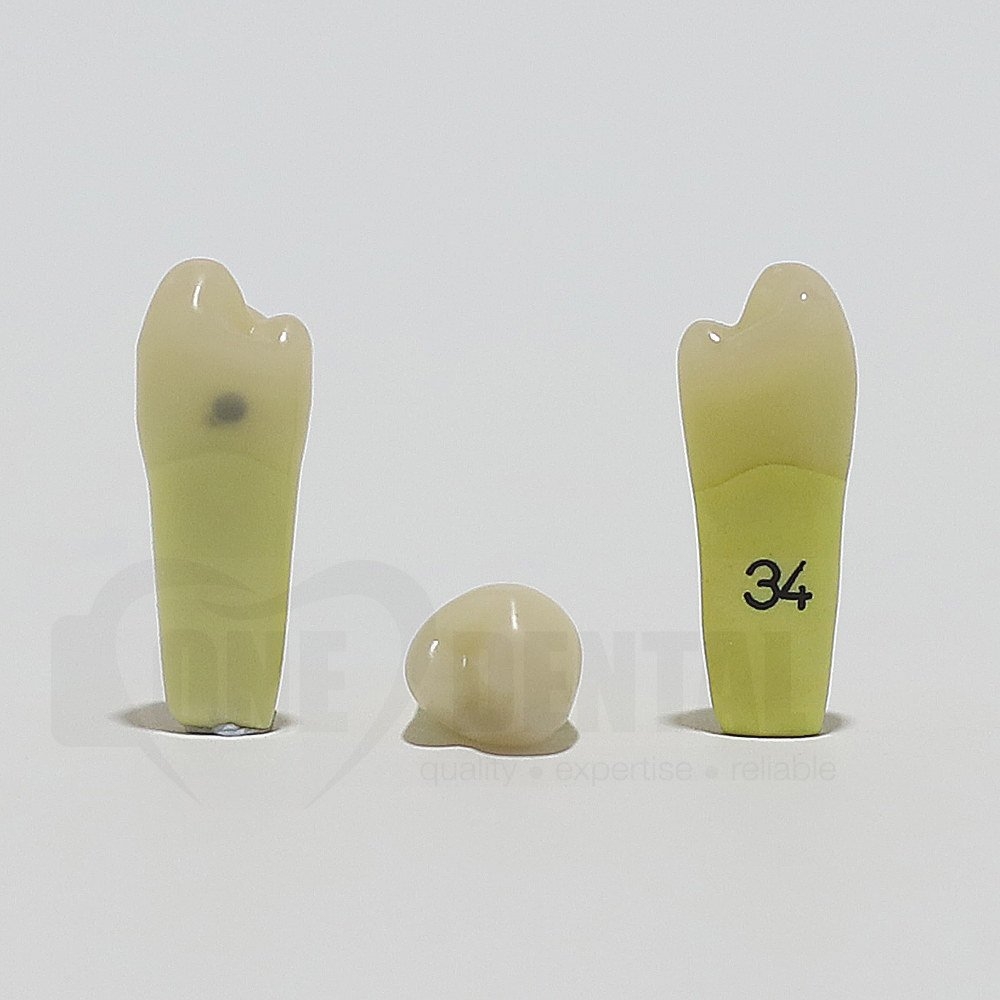 Caries Tooth 34 Distal for ADC Model