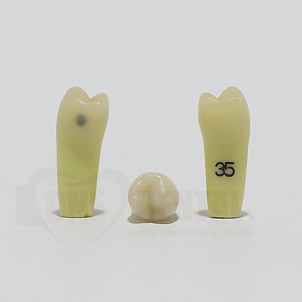 Caries Tooth 35 Distal for ADC Model