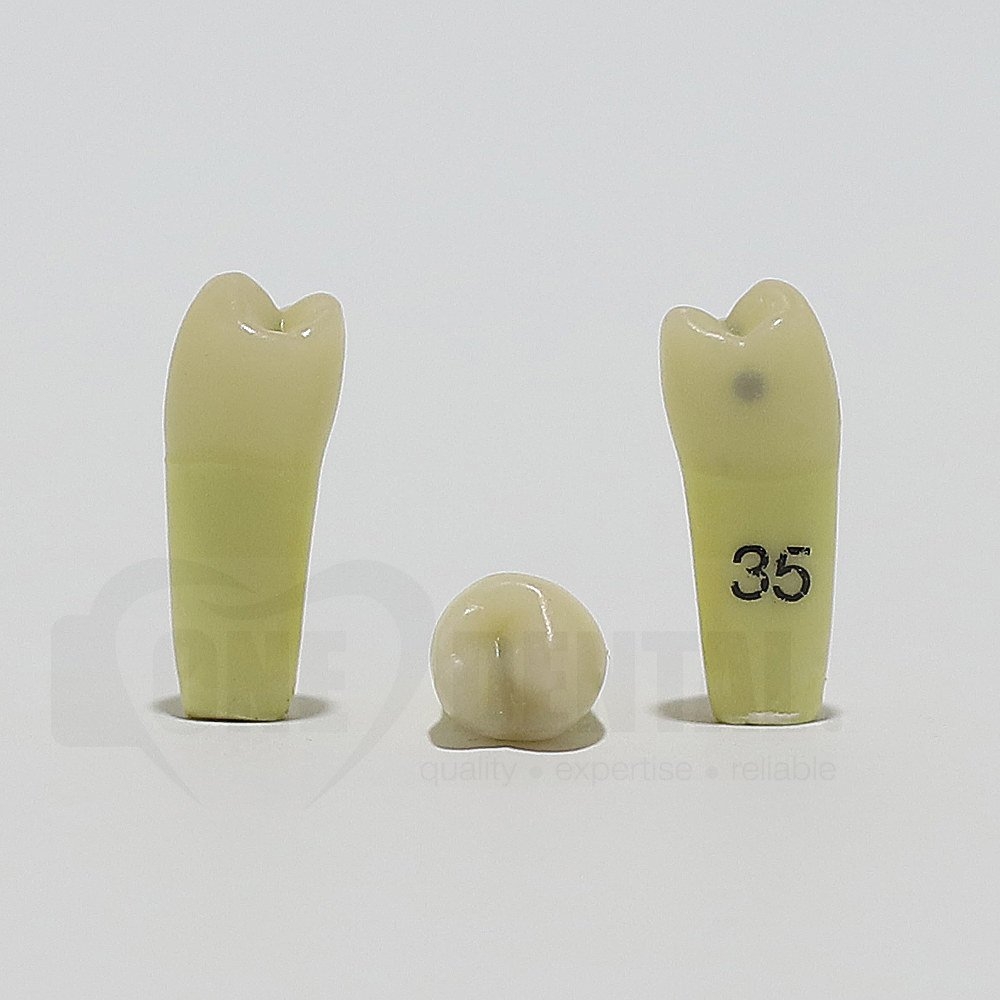 Caries Tooth 35M+O for ADC Model