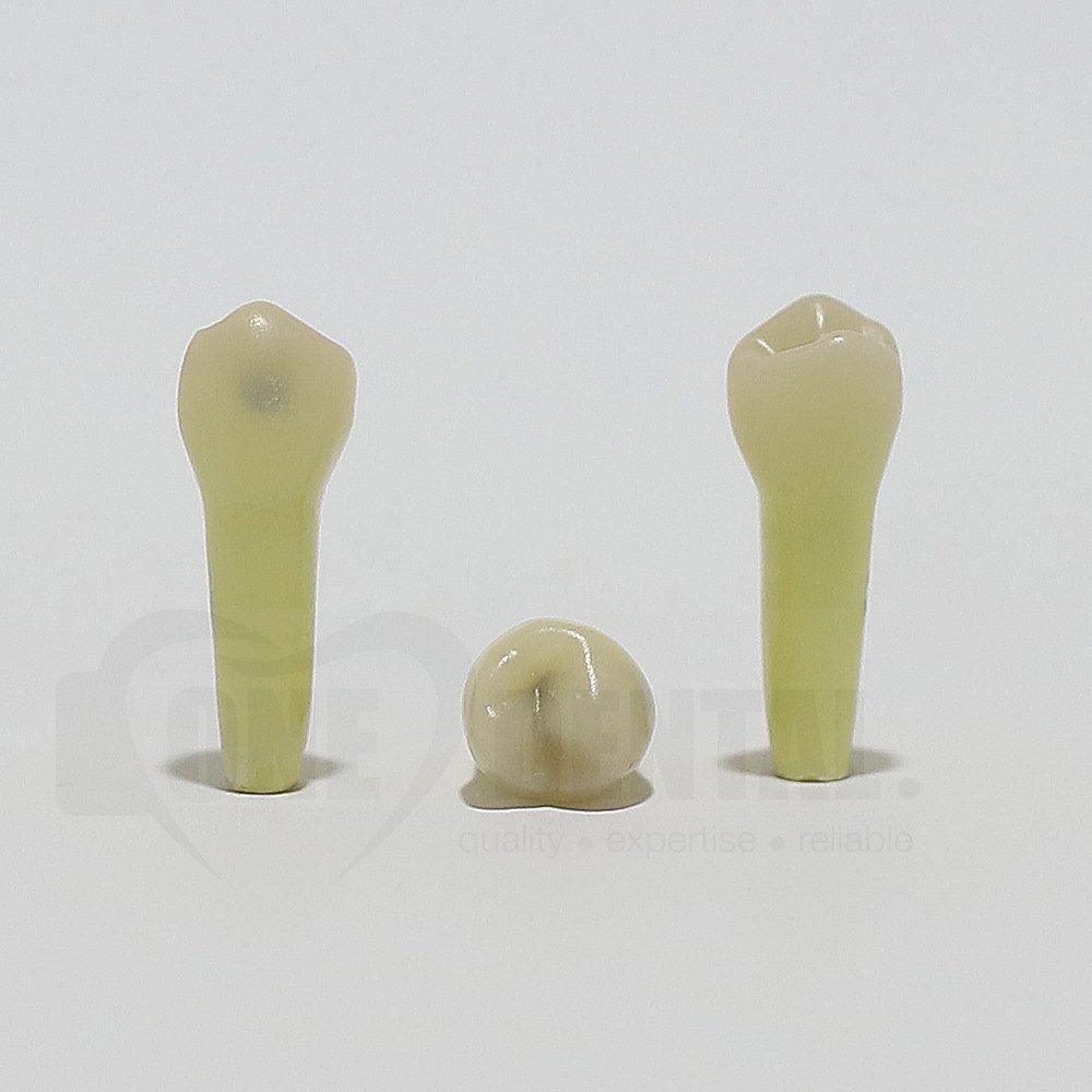 Caries Tooth 35 O+B for ADC Model