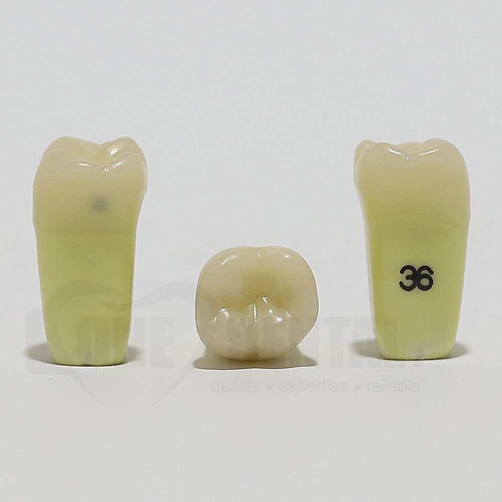 Caries Tooth 36 Distal for ADC Model
