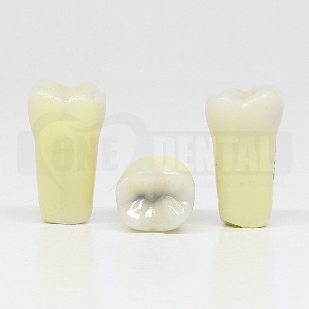 Caries Tooth 36 MOD AP undermined caries large for ADC Model