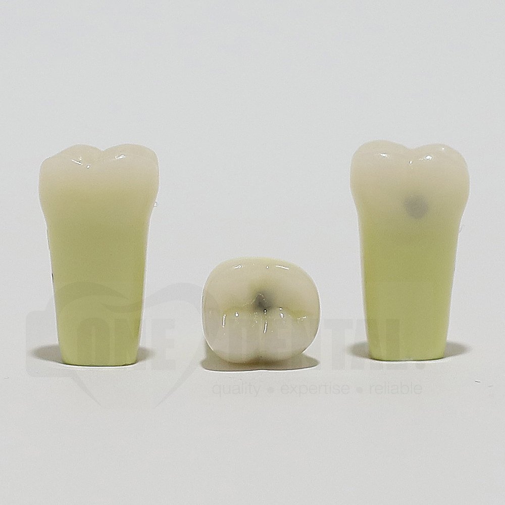Caries Tooth 37 O+B for ADC Model