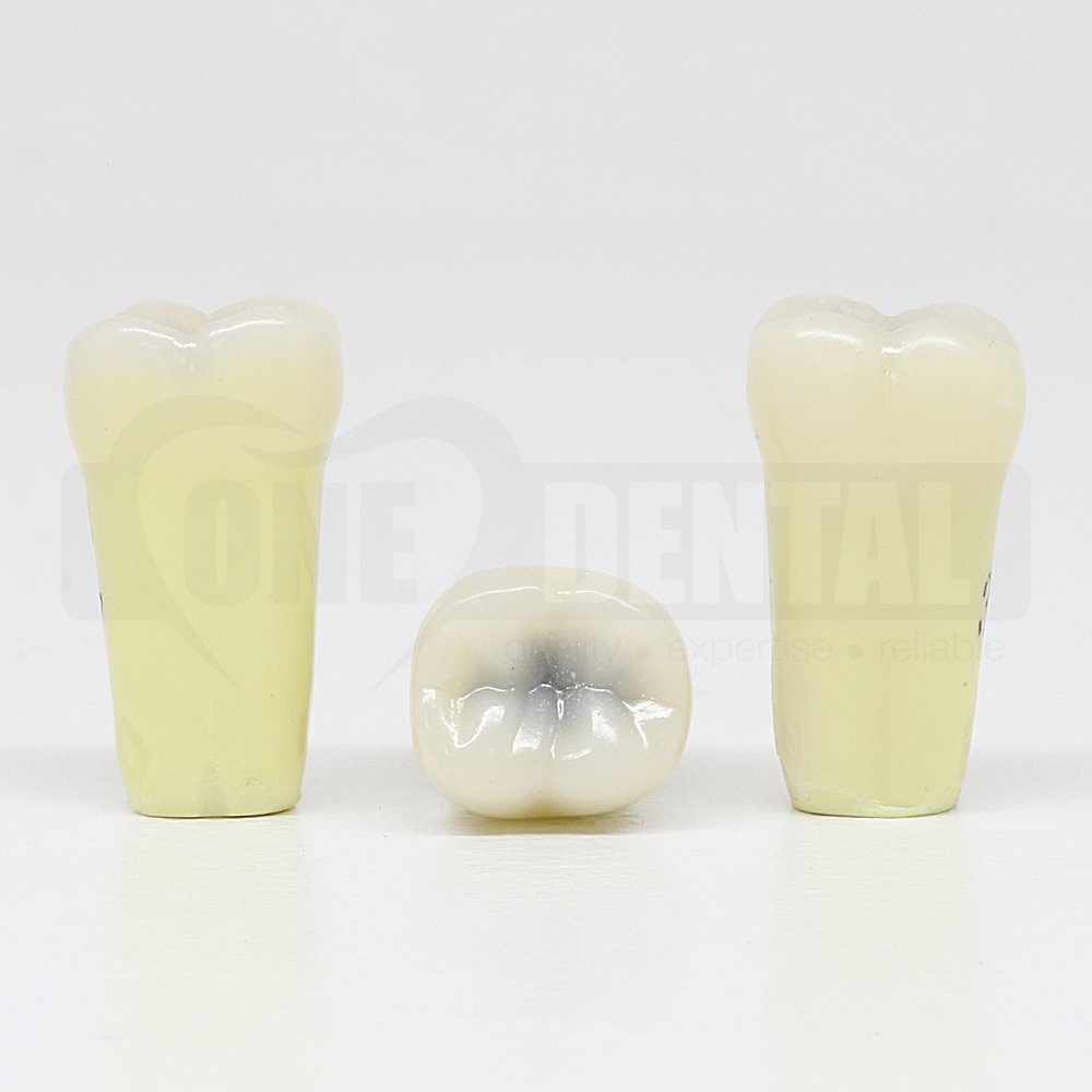 Caries Tooth 37 Occlusal Large lesion for ADC Model