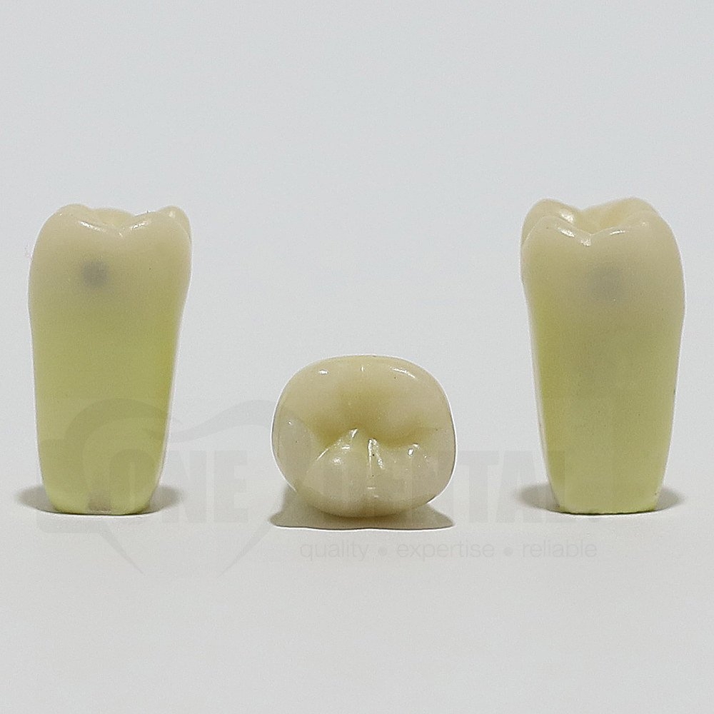 Caries Tooth 46 M+D for ADC Model