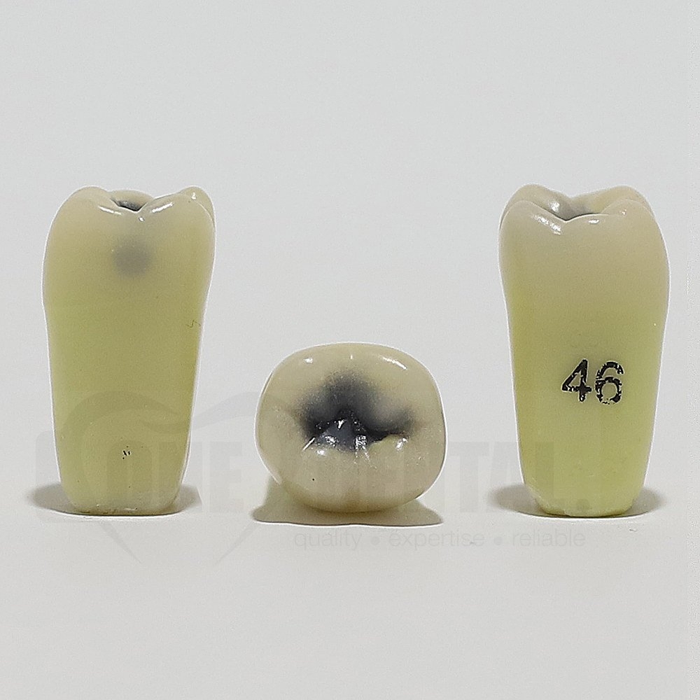 Caries Tooth 46MO Large for ADC Model