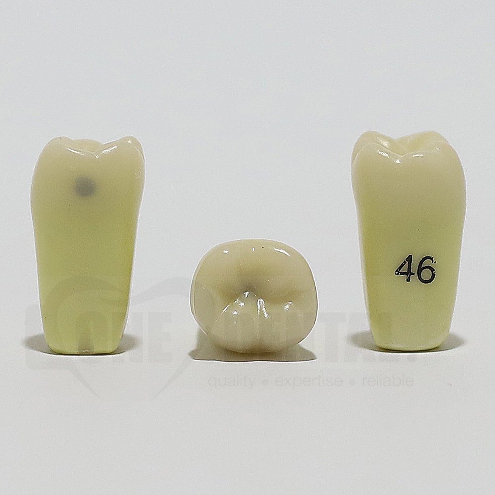 Caries Tooth 46M+O for ADC Model