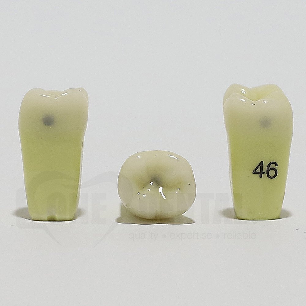 Caries Tooth 46M+O+D for ADC Model