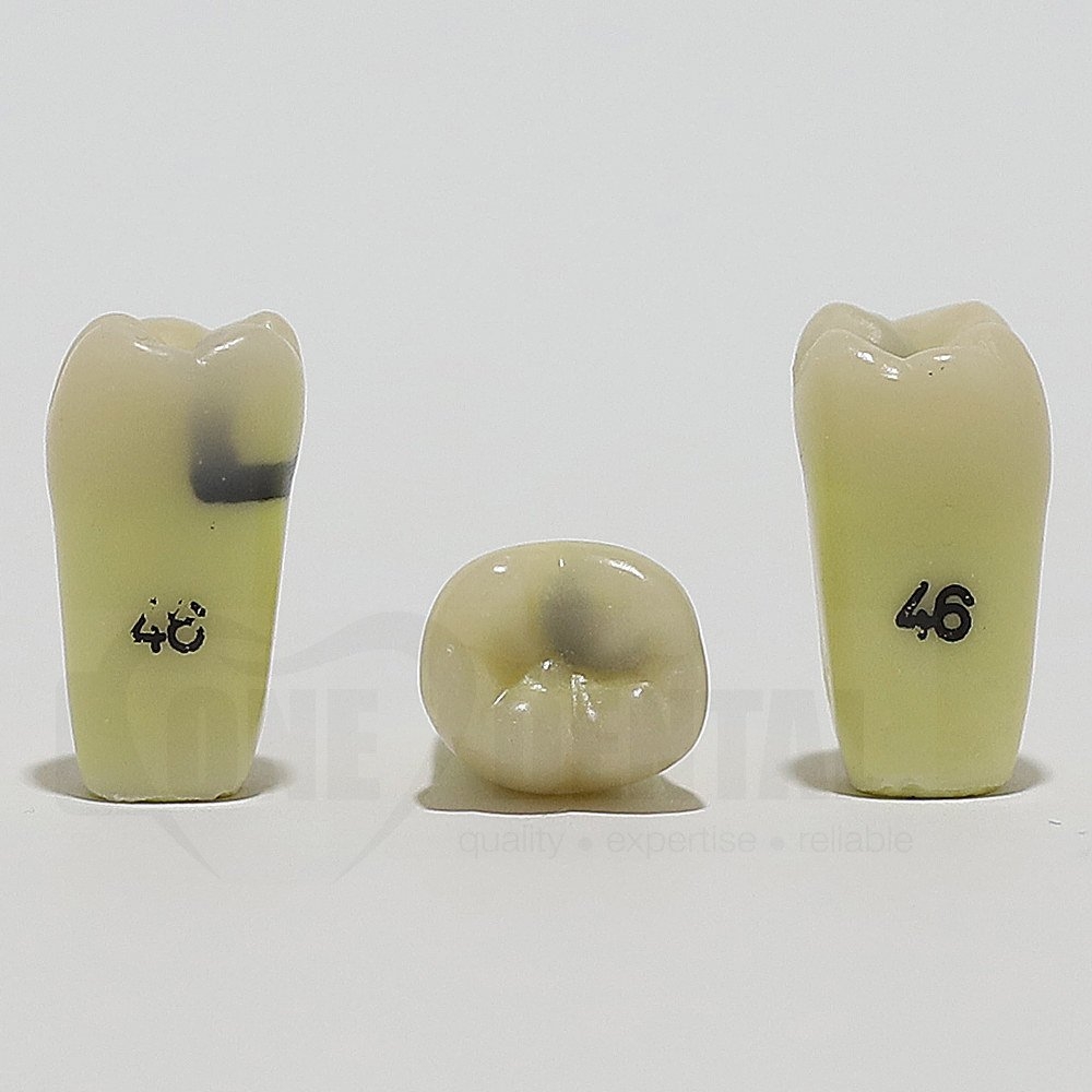 Caries tooth 46 MOL for ADC Model