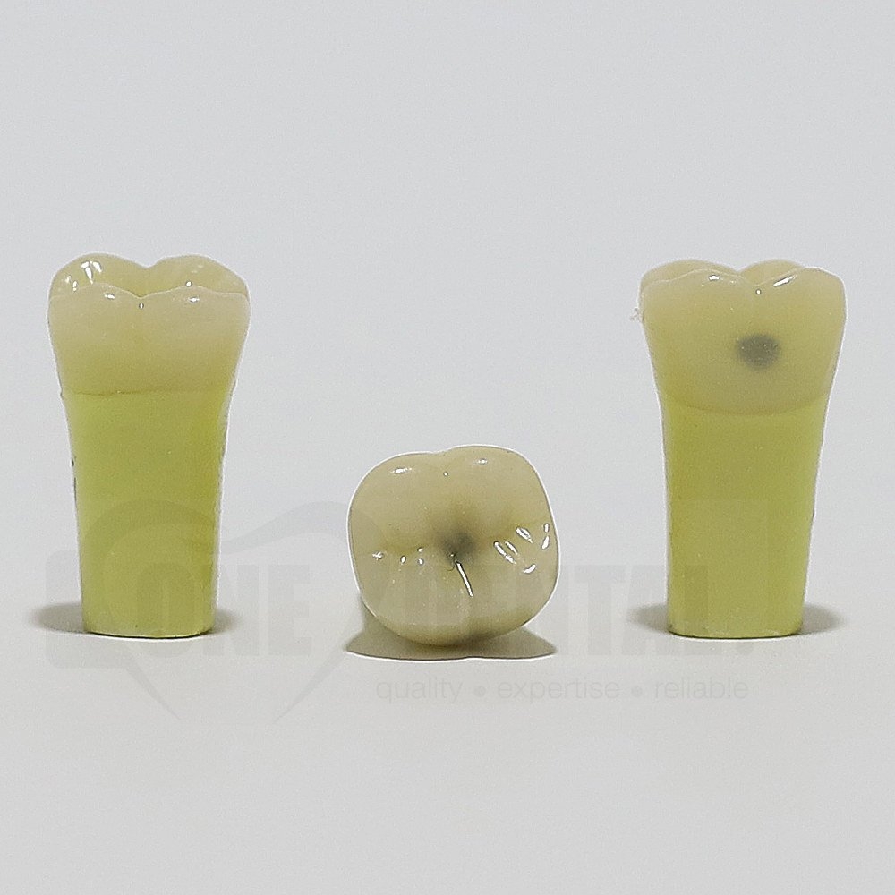 Caries Tooth 47O+B for ADC Model