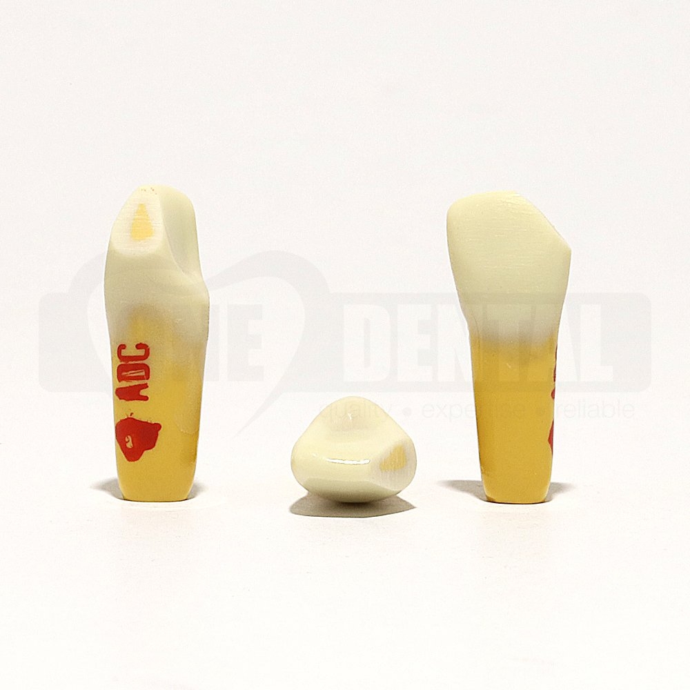Tooth 21 Dentine Enamel Fracture Mesial for ADC Model