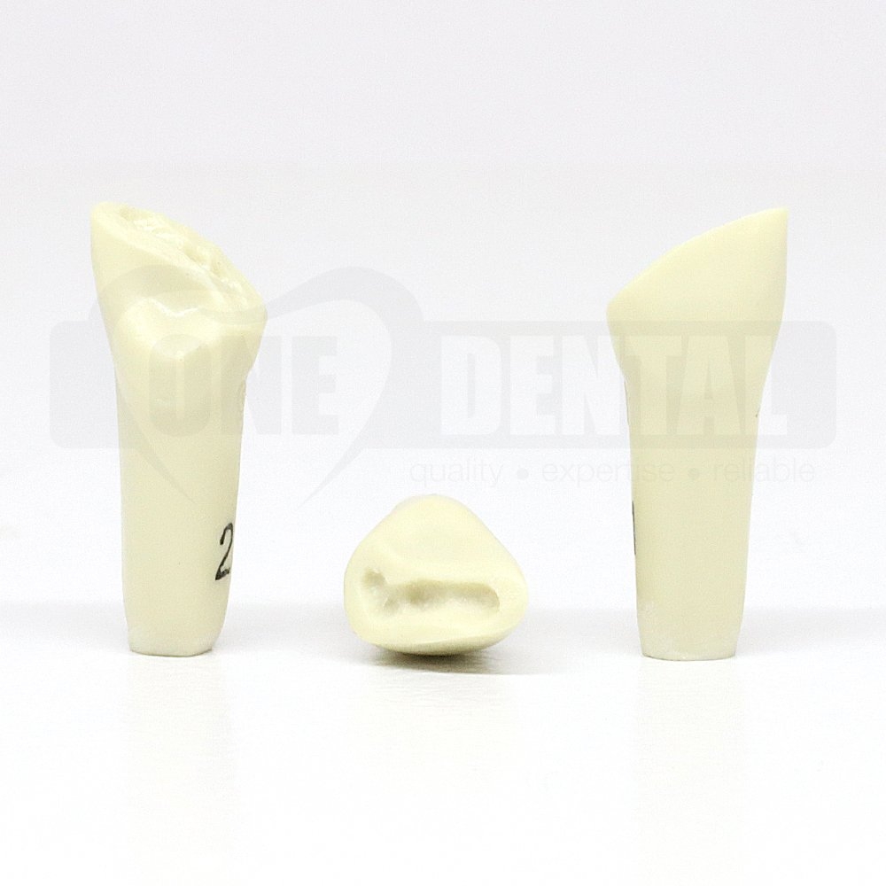 Prep Tooth 21 Distal Fracture for ADC Model