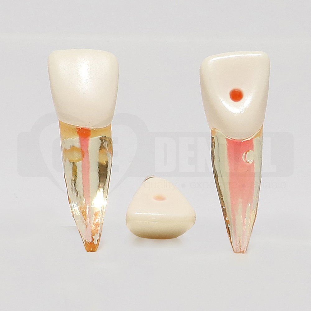 Natural Root Endo Tooth 11 With Access Cavity