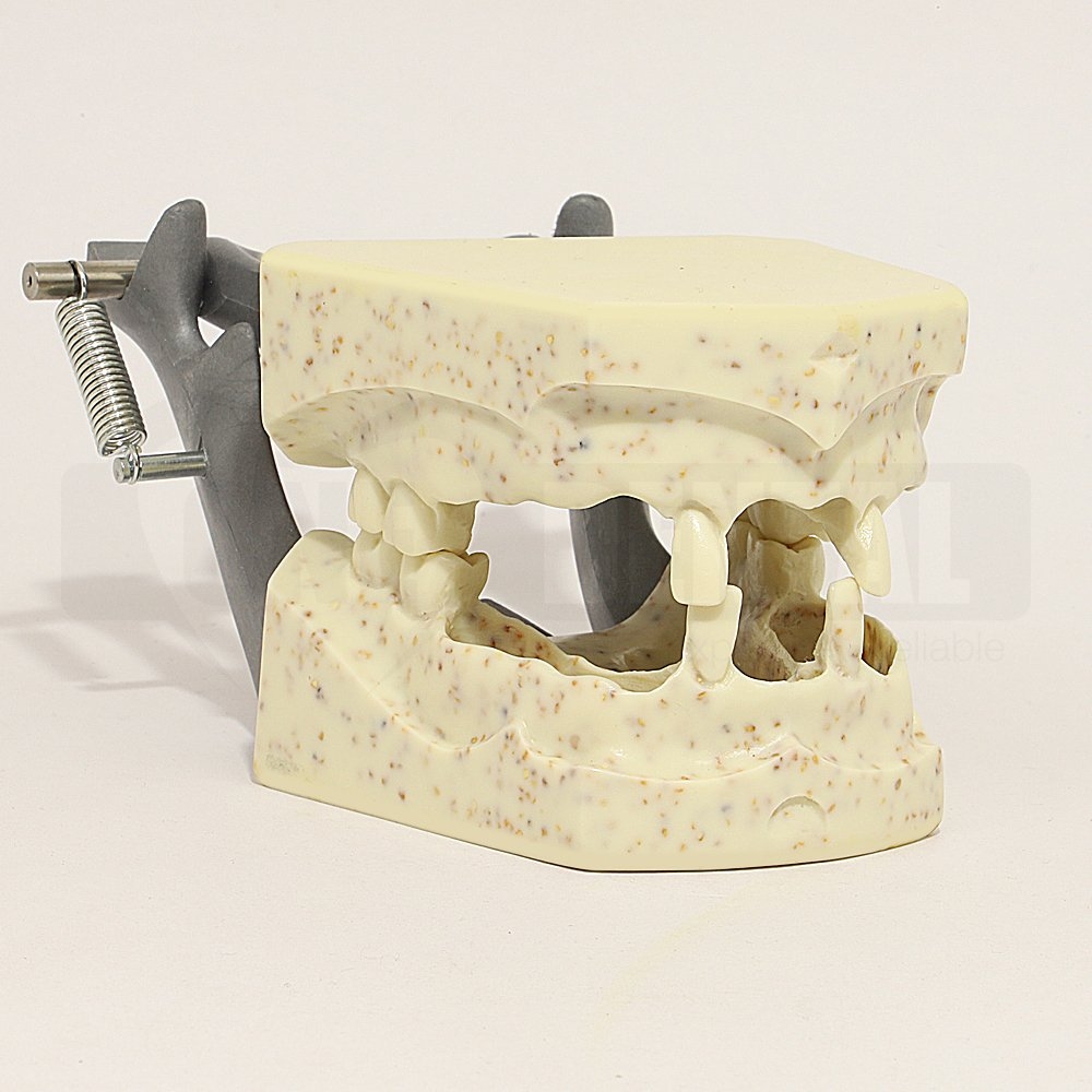 Endo Model X-865 with hinge and edentulous spaces for natural rooted teeth