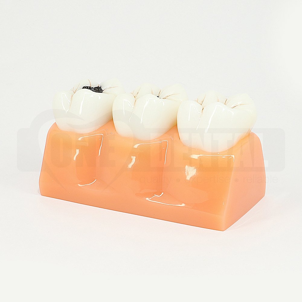 4 Times Size Staged Caries Model