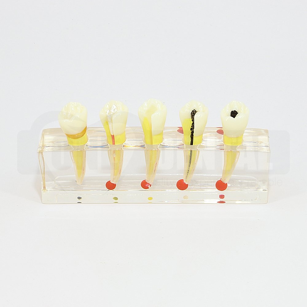 Endodontic Treatment Model with 5 stages