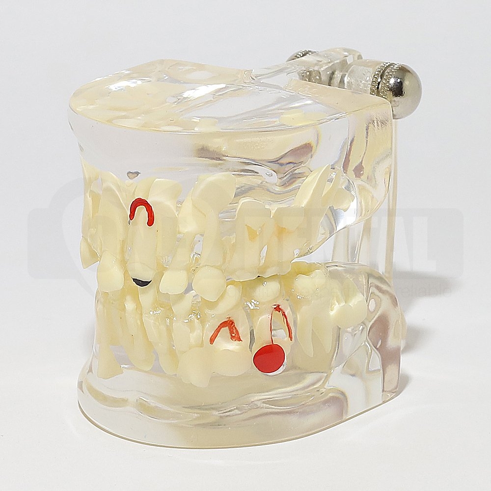 Solid Transparent Paediatric Model with Adult First Molars and Pathologies