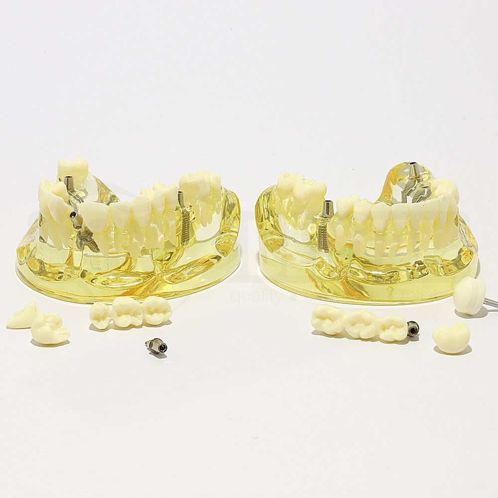 Solid Transparent Upper and Lower Implant Model