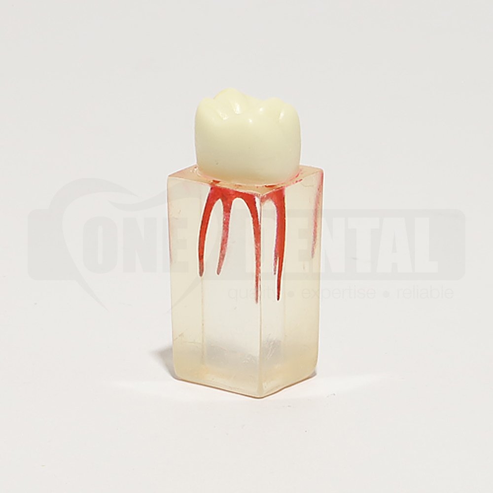 Root canal block U6 Molar Tooth 16 with Crown