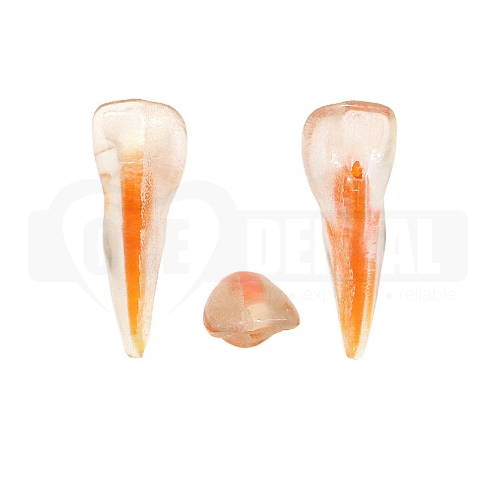 Natural Root Endo Tooth 11 with Access Cavity