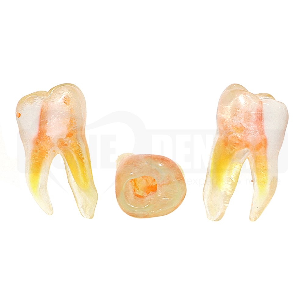 Natural Root Endo Tooth 36 with Access Cavity