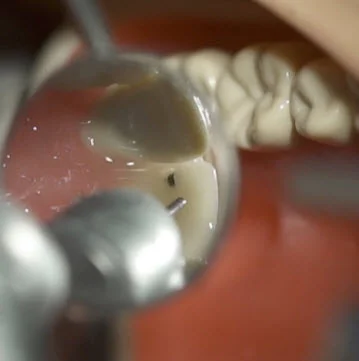 Tooth extraction