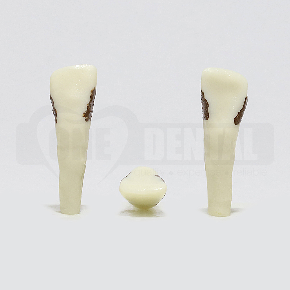 Periodontic Tooth 22